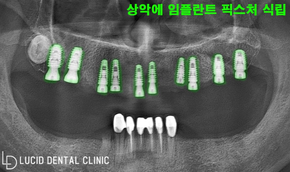 학동역 임플란트 로 무너진 수직 고경, 되찾을 수 있어요! 관련 이미지 3