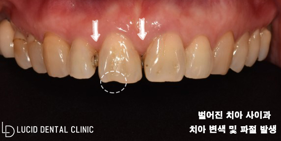 "앞니가 벌어져서 너무 보기 싫어요." 정중이개로 고민 중이던 환자분, 신논현역 치과 에서 라미네이트 로 해결해 드린 사례 관련 이미지 1