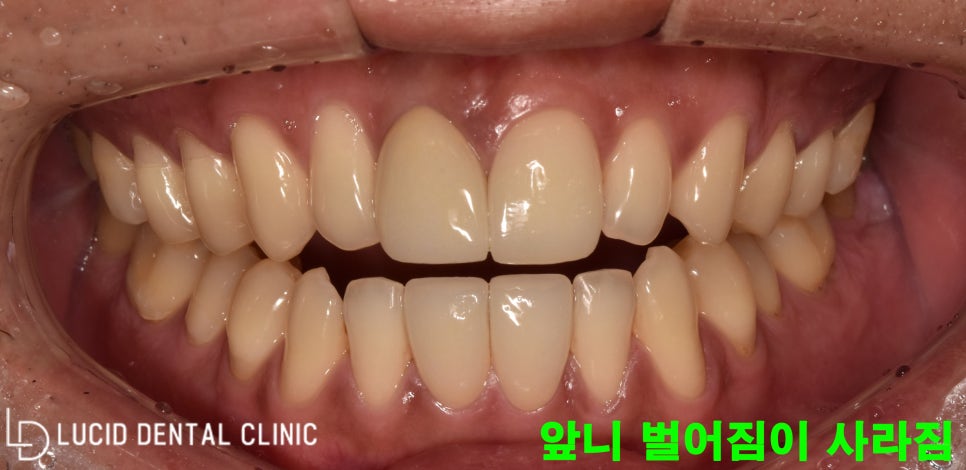 학동역 라미네이트 로 벌어진 앞니를 예쁘게 바꿔드렸어요! 관련 이미지 3