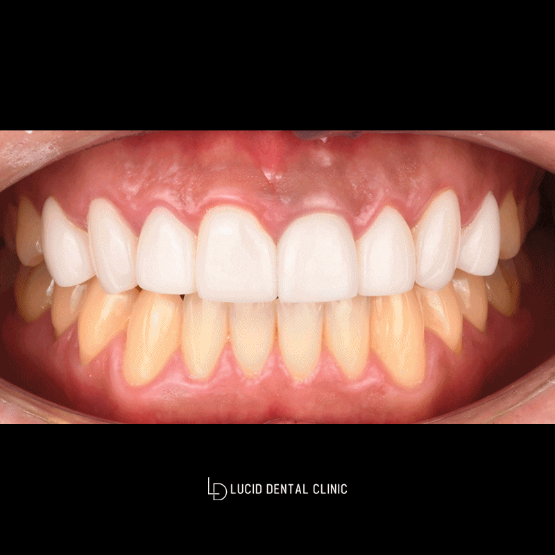 Laminates Retreatment: A Case That Changed from Unnatural to Natural image 3