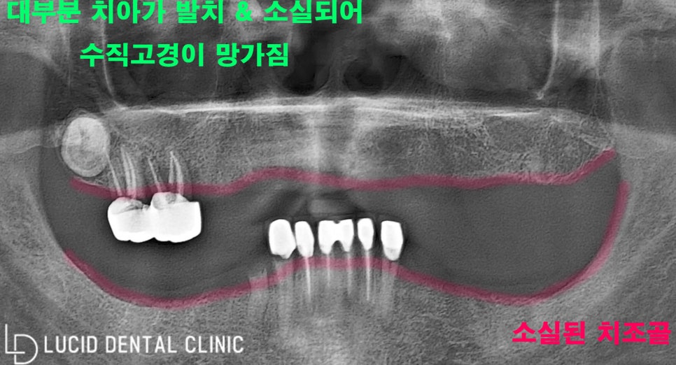 학동역 임플란트 로 무너진 수직 고경, 되찾을 수 있어요! 관련 이미지 1