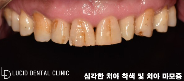 심각한 치아 변색과 마모증, 논현역 치과 에서 라미네이트 로 치료가 가능한 곳은? 관련 이미지 1