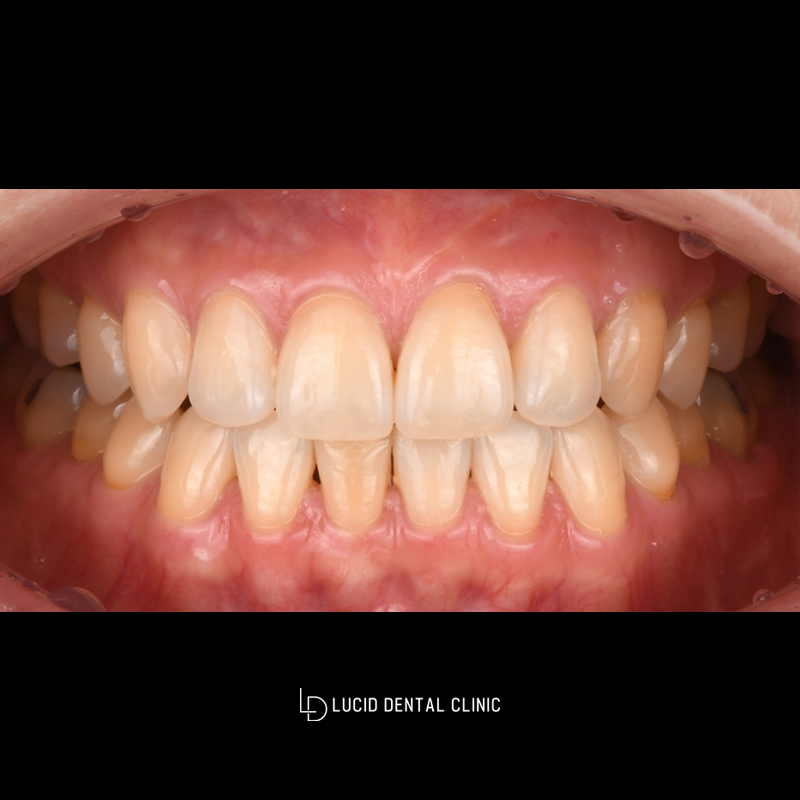 Worried About Yellow Teeth? A Case Improved with Lucinate image 1