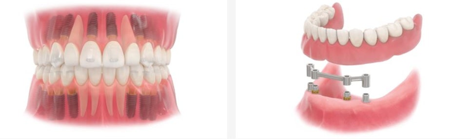 역삼역 치과 루시드 에서 알려드리는 임플란트와 브릿지, 틀니 관련 이미지 3