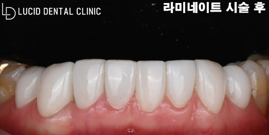 "앞니가 벌어져서 너무 보기 싫어요." 정중이개로 고민 중이던 환자분, 신논현역 치과 에서 라미네이트 로 해결해 드린 사례 관련 이미지 6