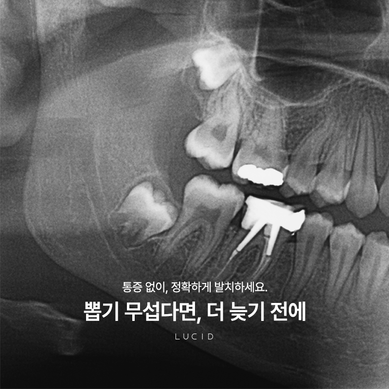 강남역 근처 치과 사랑니발치 후 운동 가능한 시점 관련 이미지 1