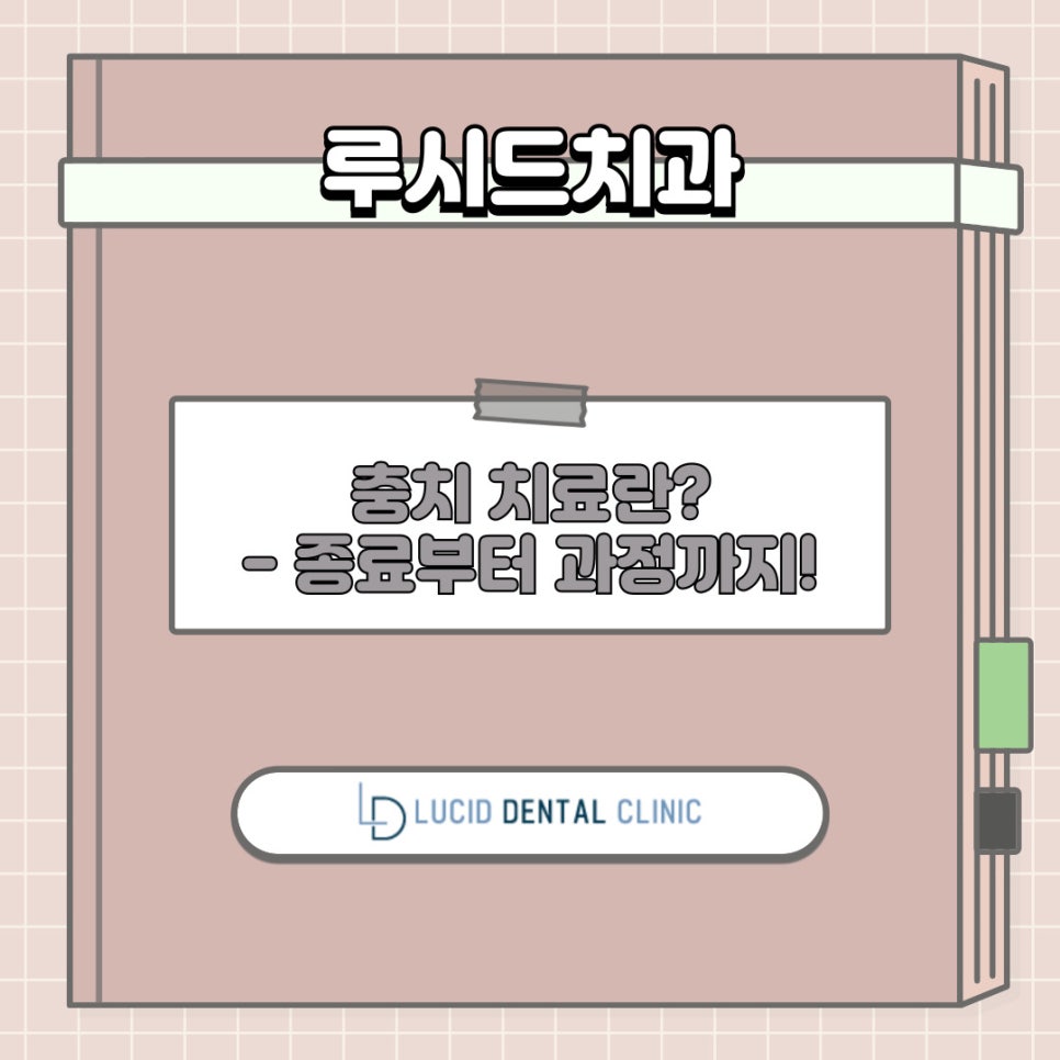 치아 충치 치료, 종류부터 과정까지 신논현역 치과 에서 알려드리겠습니다! 관련 이미지 1