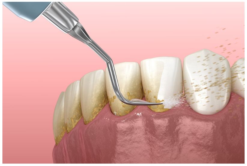 신논현역 치과 "삐뚤빼뚤하고 높이가 안 맞는 치아" 하루 만에 라미네이트(Laminate Veneer) 수복 관련 이미지 2