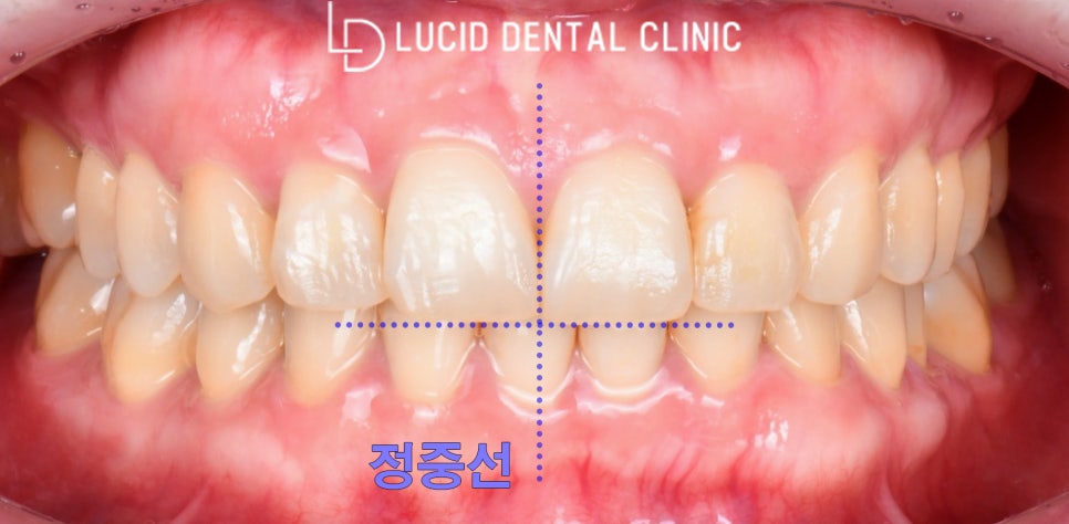 누렇게 변색한 치아, 논현역 치과 최소 삭제 라미네이트 시술로 연예인처럼 예쁘게 만들어 드렸습니다! 관련 이미지 1