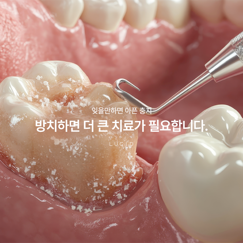 Yeongdeungpo Station Dentist: From the Causes of Cavities to Stage-by-Stage Symptoms image 2