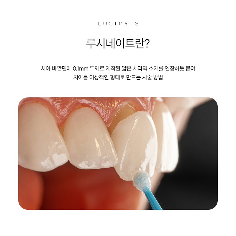 Sinnonhyeon Station Dental Clinic: The Completion of Luxury with Minimal-Reduction Laminate image 3