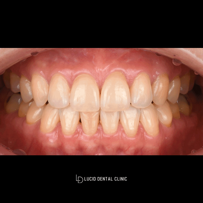 Worried About Yellow Teeth? A Case Improved with Lucinate image 3