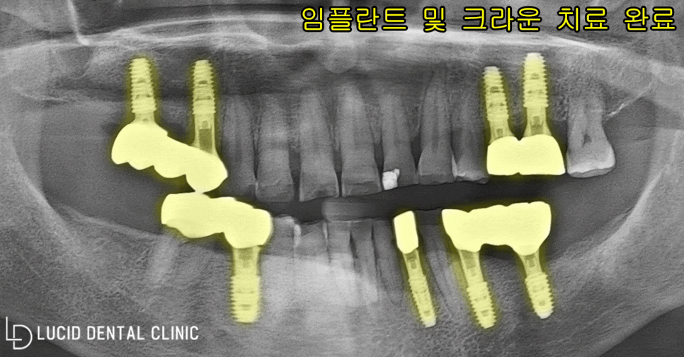 다수의 치아 상실, 임플란트 잘하는 논현동 치과 치료로 구강 건강 되찾아드렸습니다. 관련 이미지 3