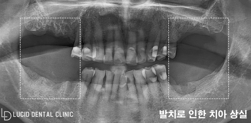 비어있는 어금니 치아와 소실된 기능, 강남역 치과 임플란트 수술로 회복할 수 있었던 이유 관련 이미지 2