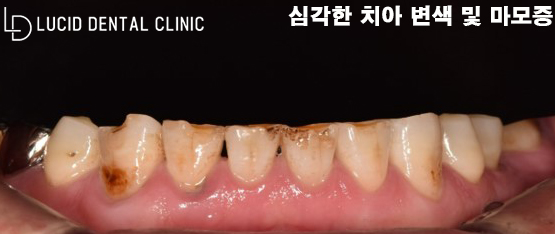 심각한 치아 변색과 마모증, 논현역 치과 에서 라미네이트 로 치료가 가능한 곳은? 관련 이미지 2