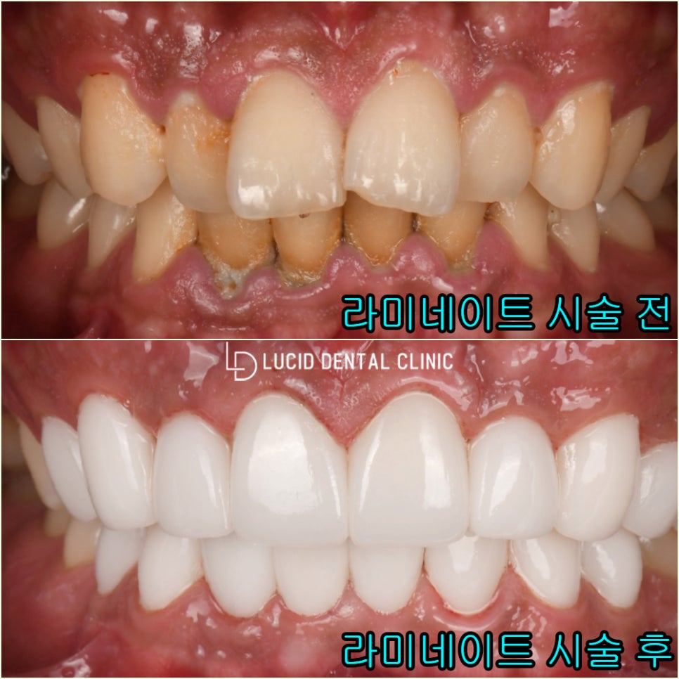 논현역 치과 치아교정없이 틀어진 앞니 토끼이빨 배열 개선 가능한 루시네이트 시술 후기 관련 이미지 5