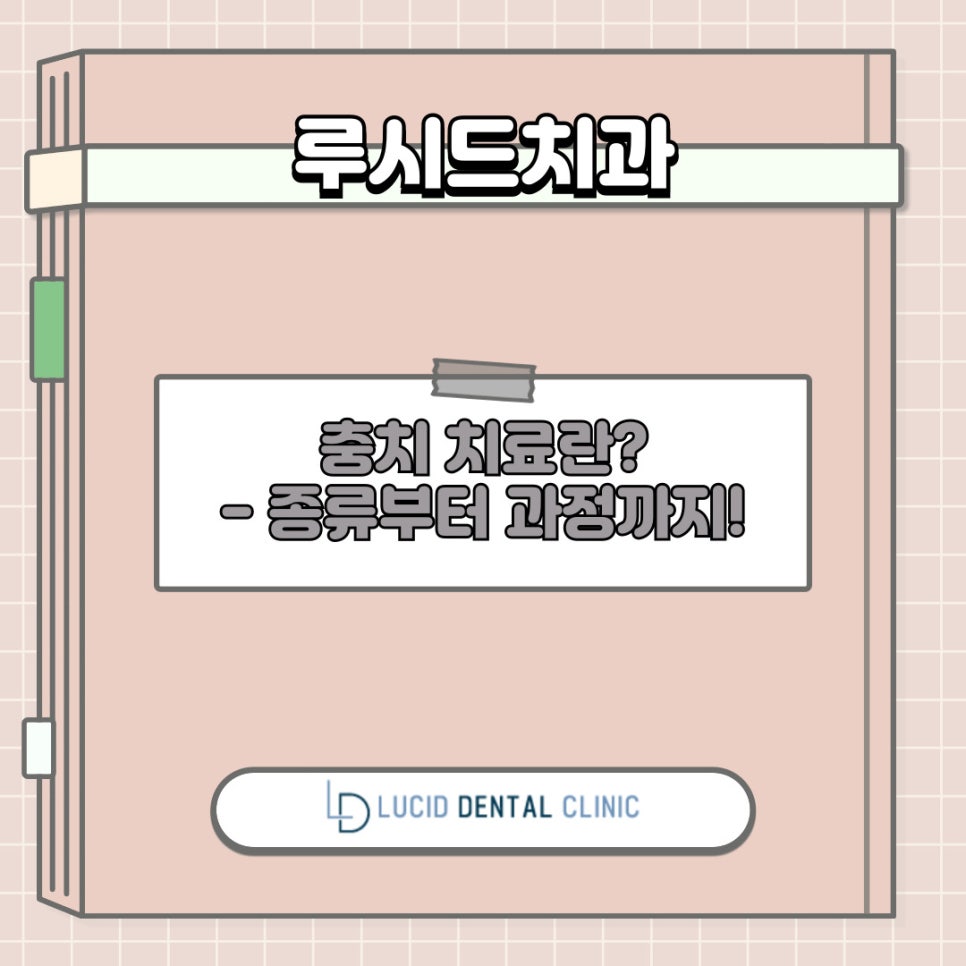 치아 충치 치료, 종류부터 과정까지 신논현역 치과 에서 알려드리겠습니다! 관련 이미지 10