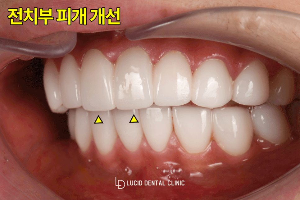 논현동 치과 에서 교정 없이, 라미네이트 시술 로 뻐드렁니 개선해 드린 사례 관련 이미지 7