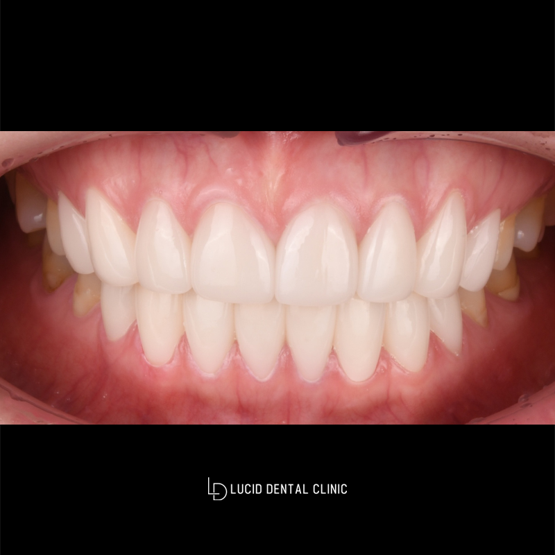 If There Is a Gap Between the Front Teeth? A Case Improved with Lucinate image 2
