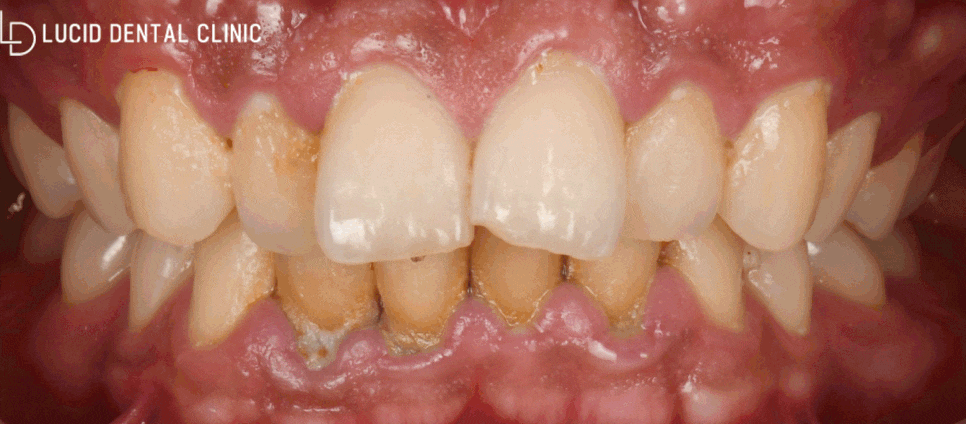 논현역 치과 치아교정없이 틀어진 앞니 토끼이빨 배열 개선 가능한 루시네이트 시술 후기 관련 이미지 4