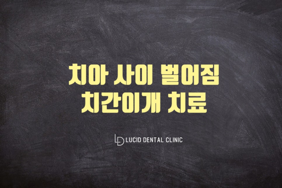 선정릉역 치과 - 이 사이 벌어짐 "치간이개" 수복방법은? (레진, 라미네이트, 크라운, 교정) 관련 이미지 1