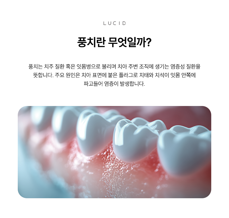 Early Signs of Periodontal Disease and Treatment Methods at a Yeoksam-dong Dental Clinic image 3