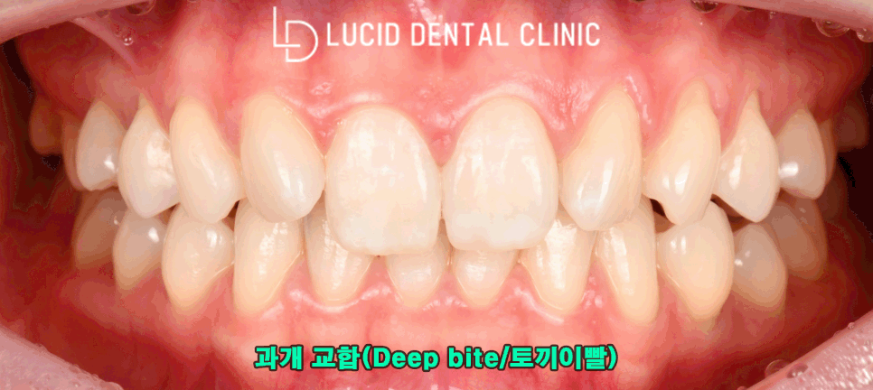 학동역 치과 과개 교합(Deep bite) 토끼 앞니 라미네이트 시술 후기 관련 이미지 1