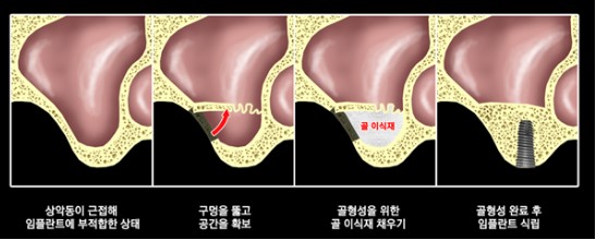자연치가 없다면? 논현동 치과 에서 임플란트 이용한 대처 방법, 기능, 편리성 알려드립니다. 관련 이미지 5
