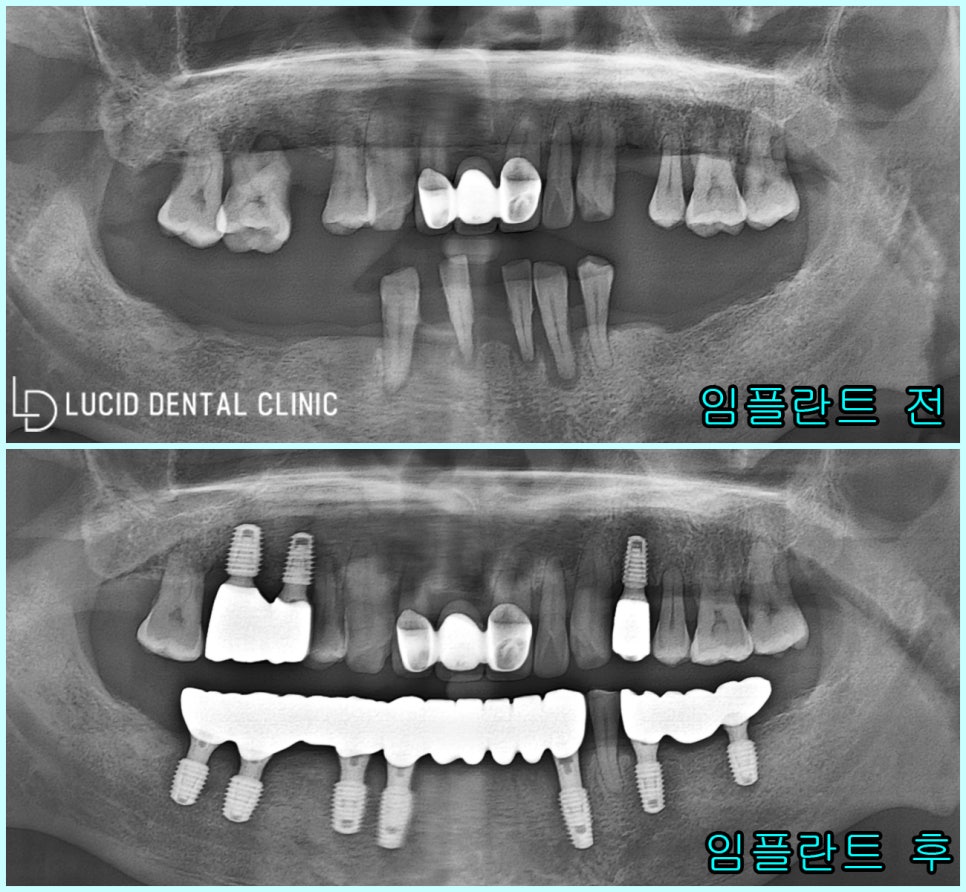서초동 치과 충치 및 정출 빠르게 해결한 위, 아래 어금니 임플란트 수술 과정 및 관리법 소개 관련 이미지 3