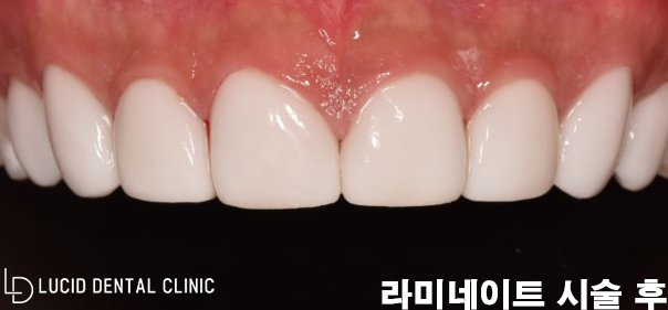 내 치아에 하얀 반점이? 교정 후 생긴 화이트 스팟 치아 탈회, 학동역 치과 에서 라미네이트 로 해결해 드렸습니다. 관련 이미지 3