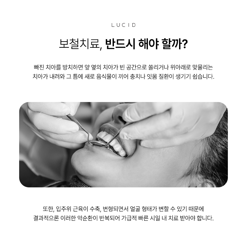 논현동치과 보철치료 전 알아두면 좋은 체크 포인트 관련 이미지 3