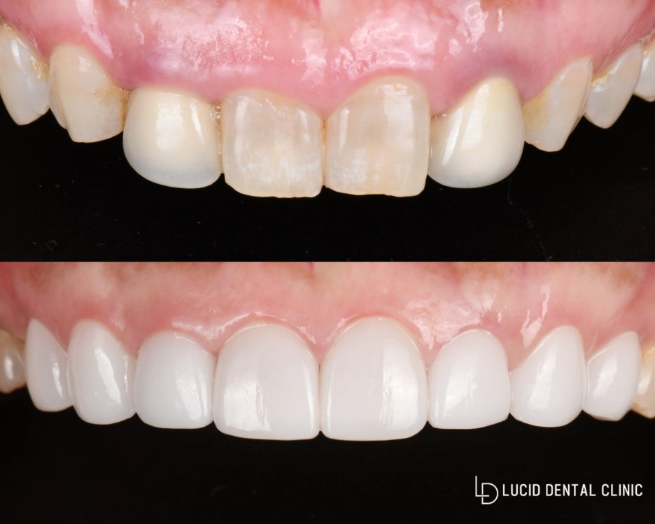 신논현역 치과 "삐뚤빼뚤하고 높이가 안 맞는 치아" 하루 만에 라미네이트(Laminate Veneer) 수복 관련 이미지 4