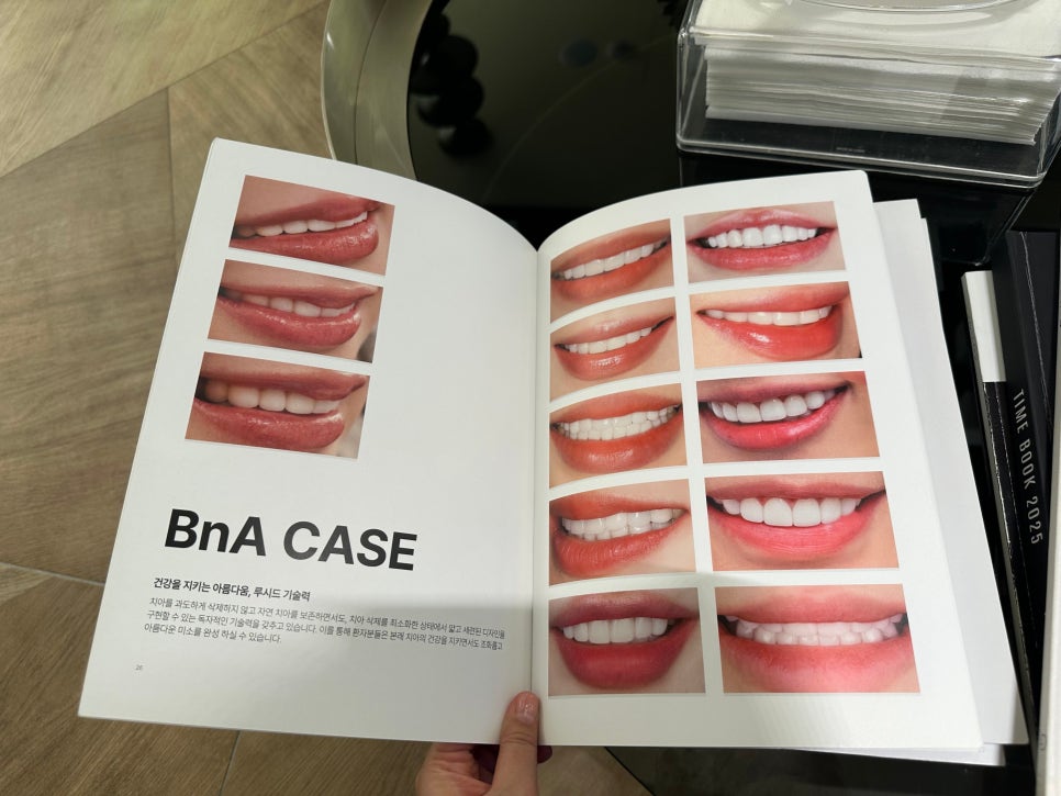 논현동치과 무삭제 라미네이트 ㅣ 가능한 조건과 최소삭제 기준 관련 이미지 7