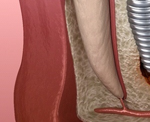 역삼동 치과 임플란트 수술 후 부작용 및 통증 원인, 해결 방법은? 관련 이미지 3