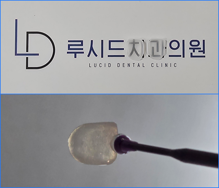 라미네이트 시술, 무삭제로 받을 수 있을까요? - 역삼역 치과 루시네이트 관련 이미지 5