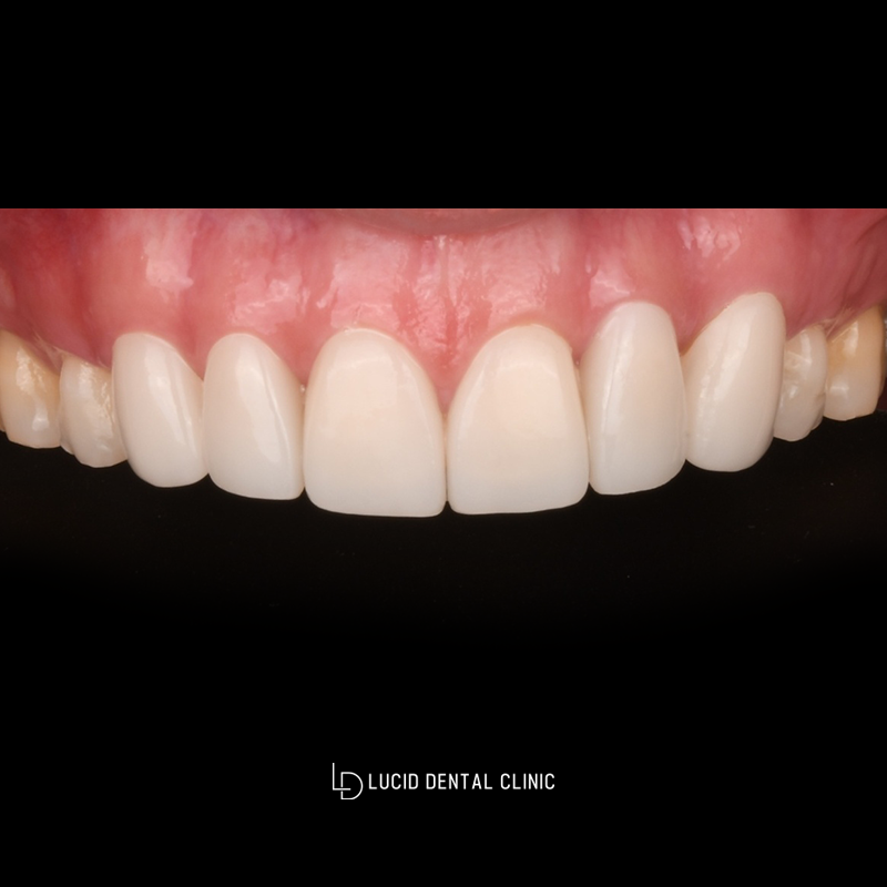 Improving the Gap Between the Front Teeth with Lucinate image 2