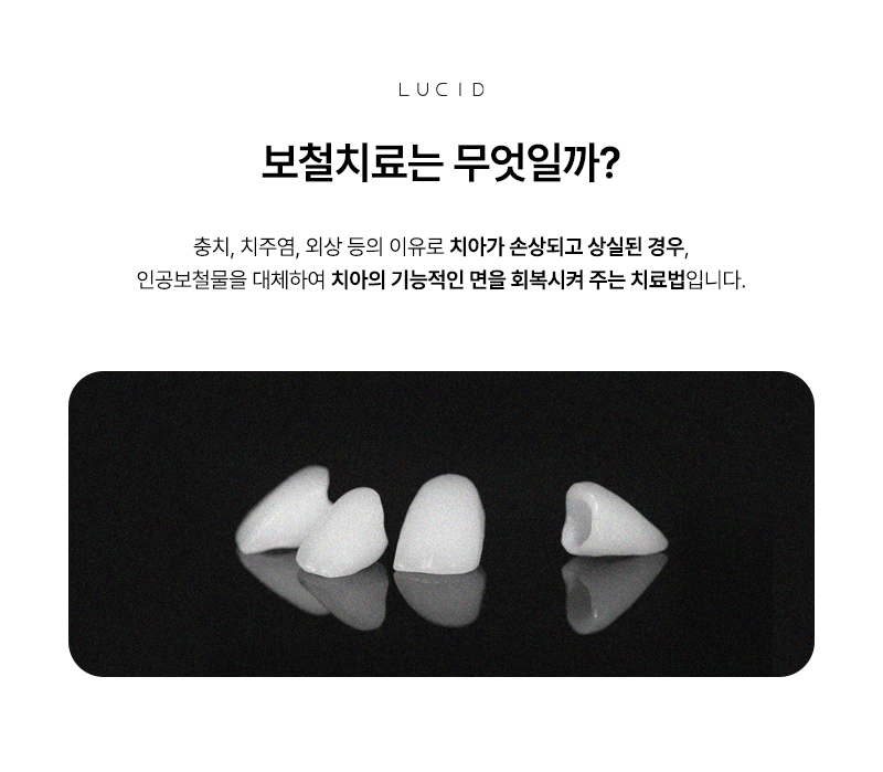 논현동치과 보철치료 전 알아두면 좋은 체크 포인트 관련 이미지 2