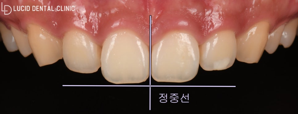 선정릉역 치과 삐뚤어진 앞니 라미네이트 시술 후기 관련 이미지 2