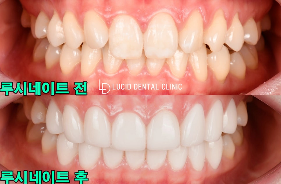 학동역 치과 과개 교합(Deep bite) 토끼 앞니 라미네이트 시술 후기 관련 이미지 4