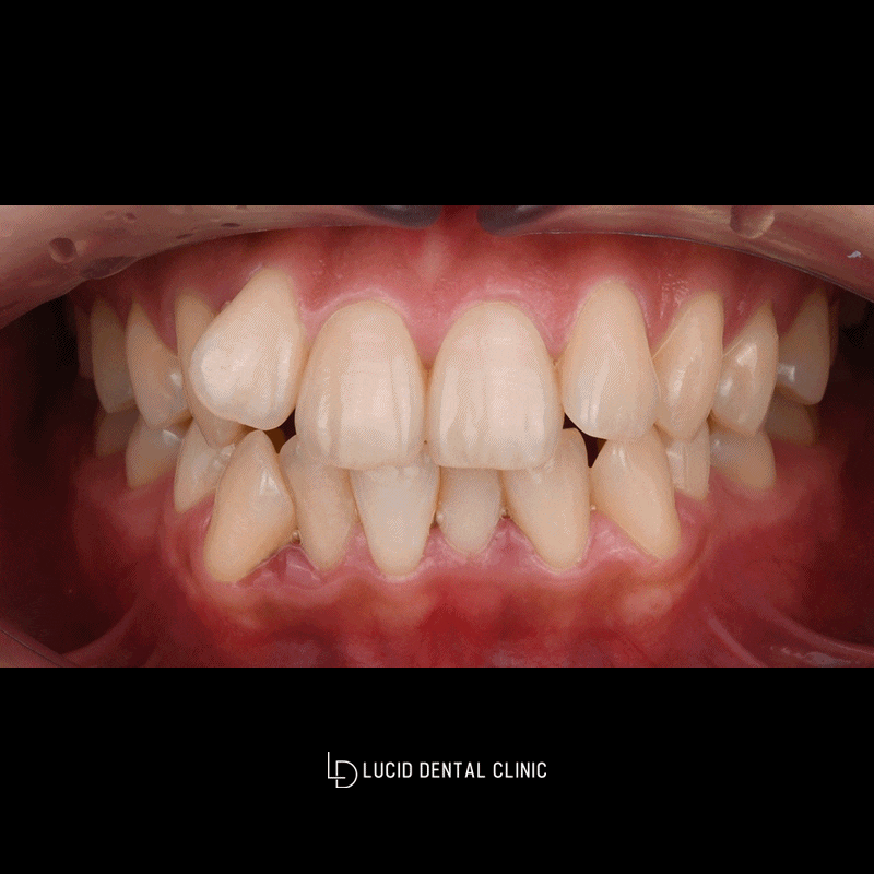 Improving Crooked Front Teeth and Uneven Tooth Alignment with Lucinate image 3