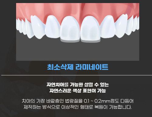 틀어진 앞니 & 치아 시림, 역삼역 치과 원데이 루시네이트로 하루만에 개선할 수 있습니다. 관련 이미지 4