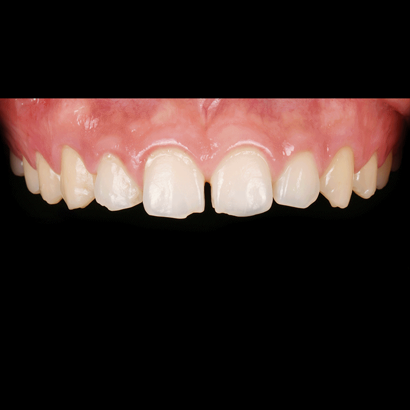 If you want to improve gapped and chipped front teeth, consider Lucinate image 3