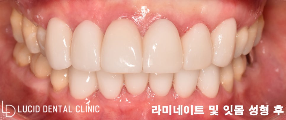 까맣게 변색된 치아, 강남역 치과 에서 라미네이트 로 해결 가능합니다! 관련 이미지 3