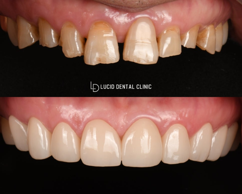 치주염으로 비어보이는 치아, 강남역 치과 에서 루시네이트 시술 후기 관련 이미지 4
