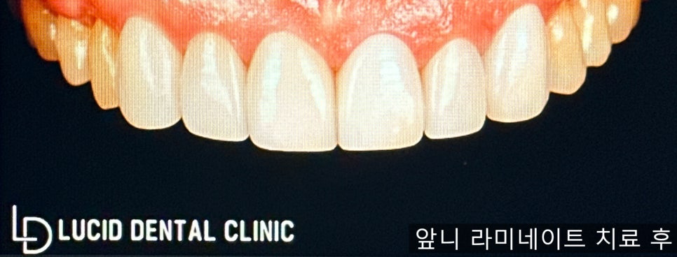 앞니 라미네이트 로 틀어진 배열과 벌어진 치아를 한 번에 개선할 수 있습니다! - 논현동 치과추천 관련 이미지 5