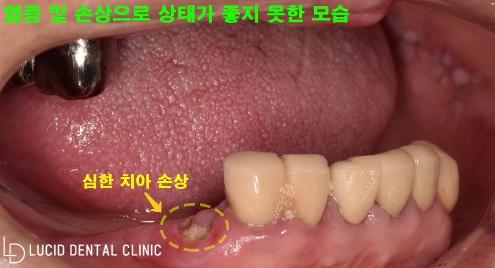 학동역 임플란트 로 무너진 수직 고경, 되찾을 수 있어요! 관련 이미지 2