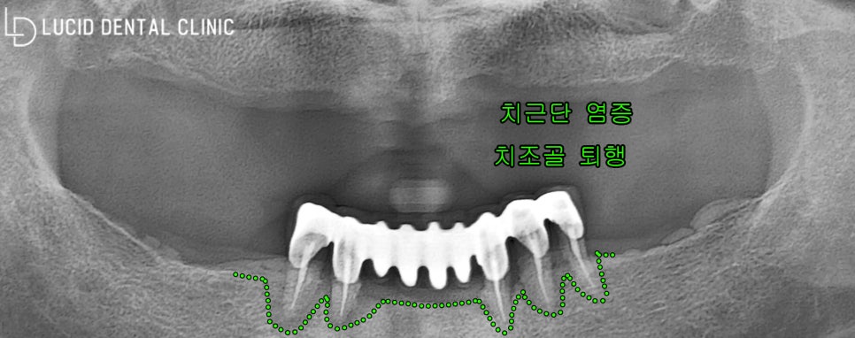 강남구청역 치과 전체 임플란트 수술, 빠르고 정확하게 받으려면? 관련 이미지 1
