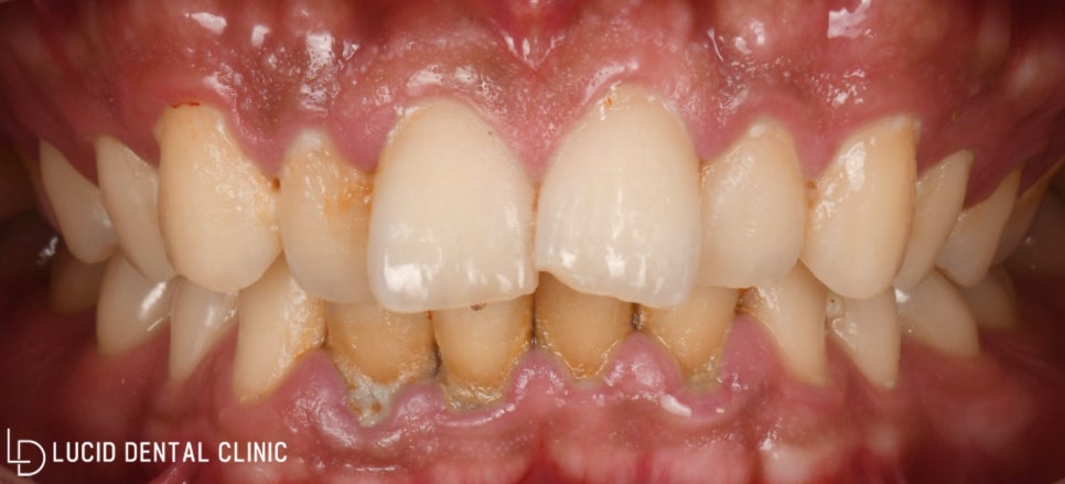 논현역 치과 치아교정없이 틀어진 앞니 토끼이빨 배열 개선 가능한 루시네이트 시술 후기 관련 이미지 1