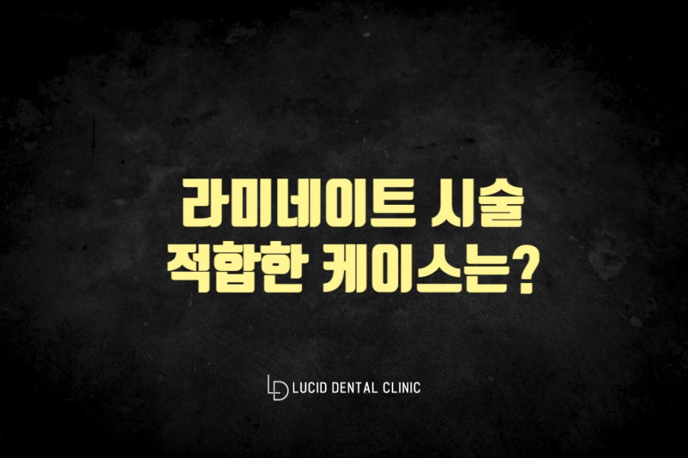 역삼동 치과 치아를 새하얗게 라미네이트 시술로 다시 새롭게 만들 수 있나요? 관련 이미지 3