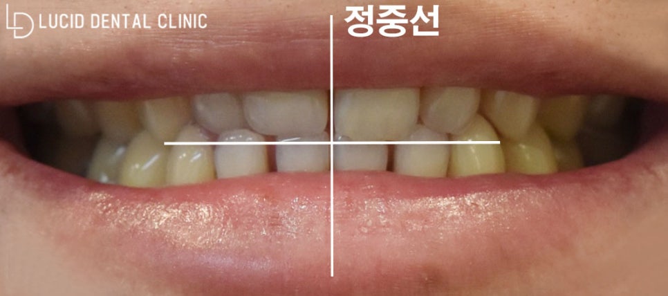 "제 치아가 너무 누렇고 안 예뻐요!" 강남역 치과 추천 받고 오신 환자분들의 앞니 라미네이트 치료 모음집 관련 이미지 7